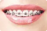 Brackets metalicos