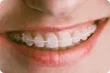 Brackets ceramicos