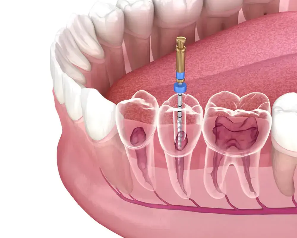 endodoncia