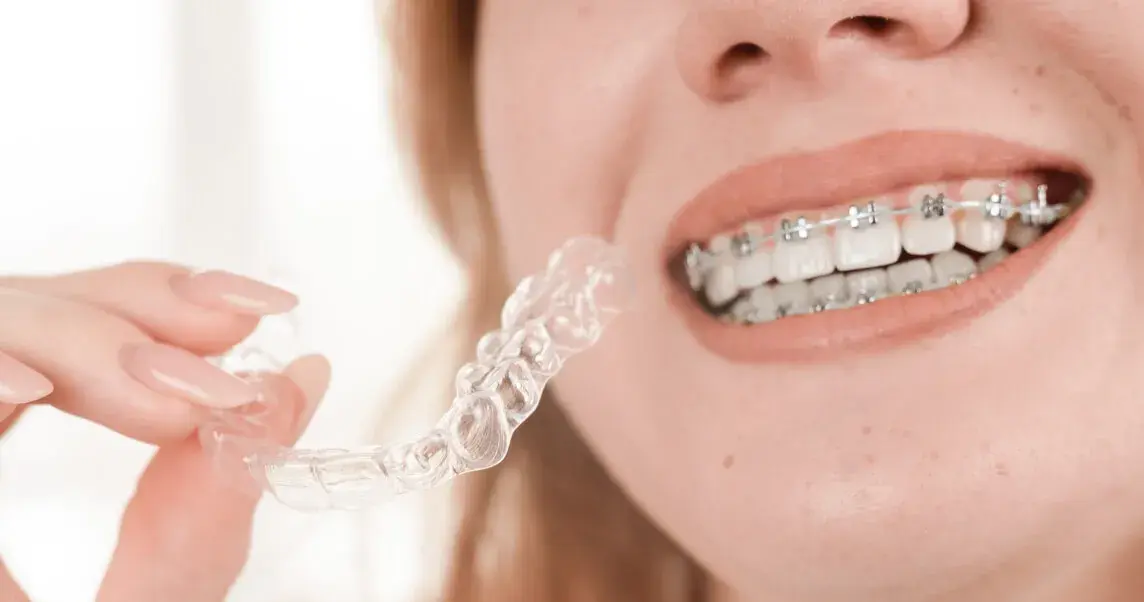 Ortodoncia invisible vs. brackets: ¿Cuál es la mejor opción para ti?