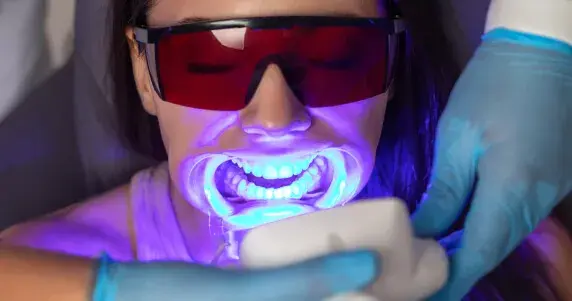 Blanqueamiento en clínica vs. en casa: ¿Cuál es la mejor opción para tu sonrisa?