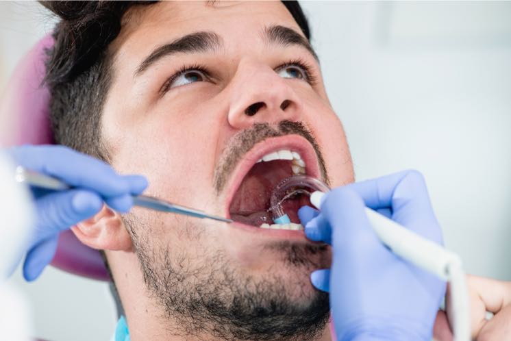 Diferencias entre raspado y limpieza dental - Clínica Dental Adeslas