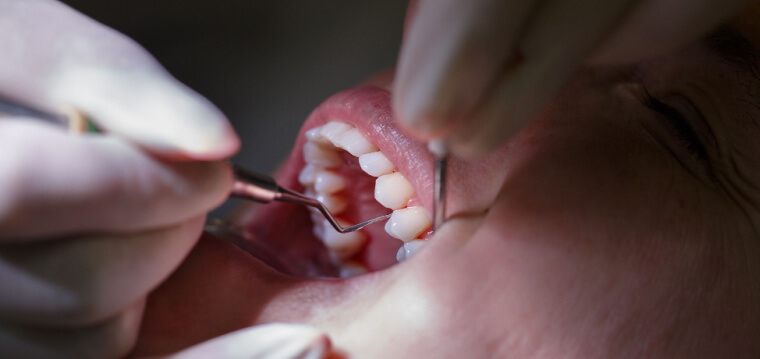 ¿Cómo se realiza el tratamiento de raspado dental? - Clínica Dental Adeslas