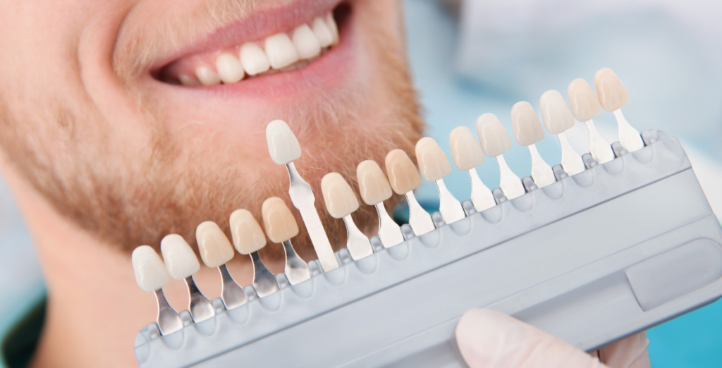 Qué son las carillas dentales?