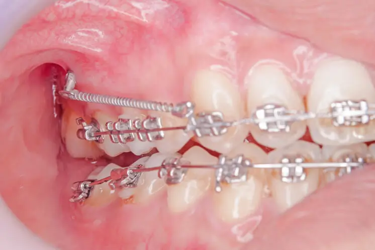 detalle de microimplantes dentales