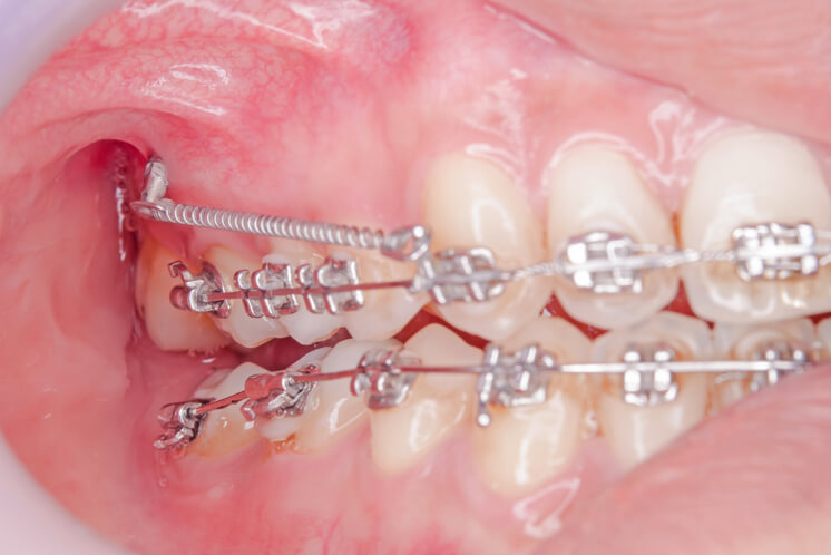 detalle de microimplantes dentales