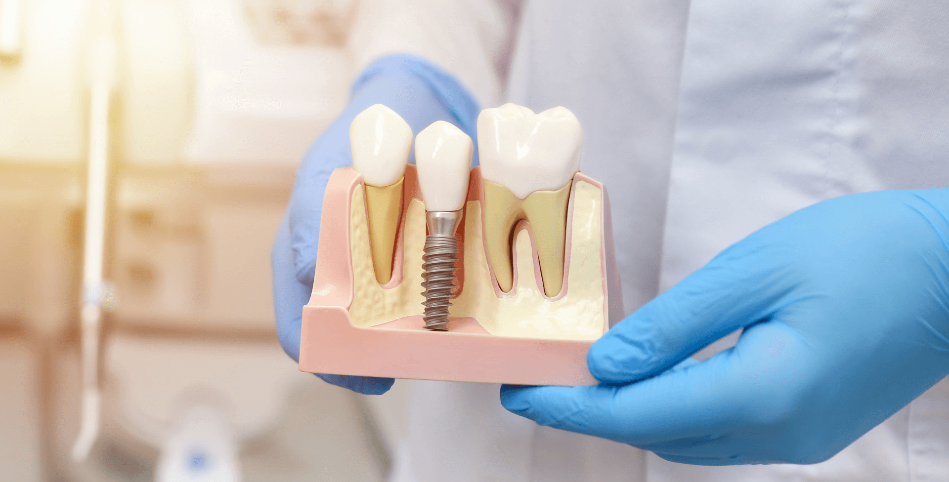 10 razones para elegir implantes dentales