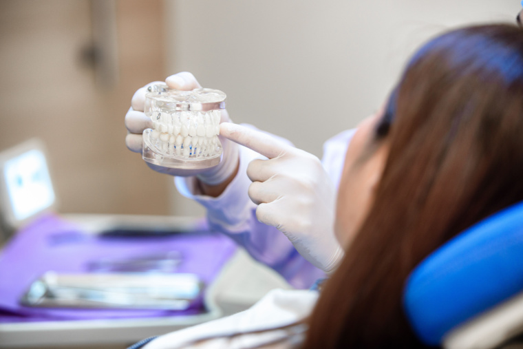 Material de los implantes dentales - Clínica Dental Adeslas