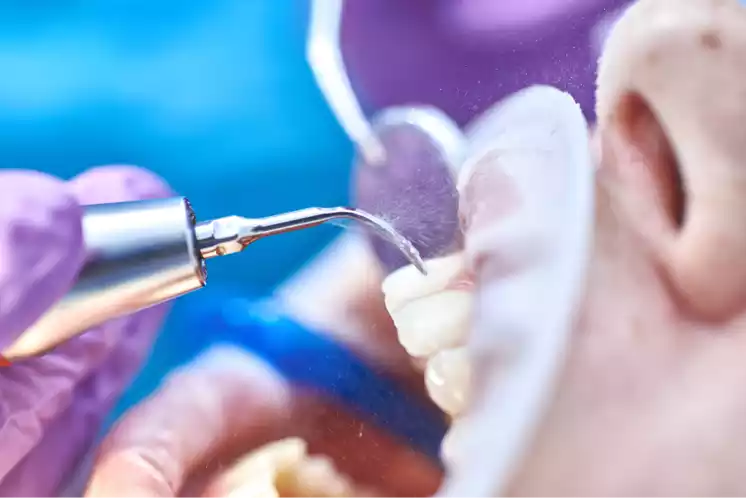Aplicación de limpieza dental por ultrasonido