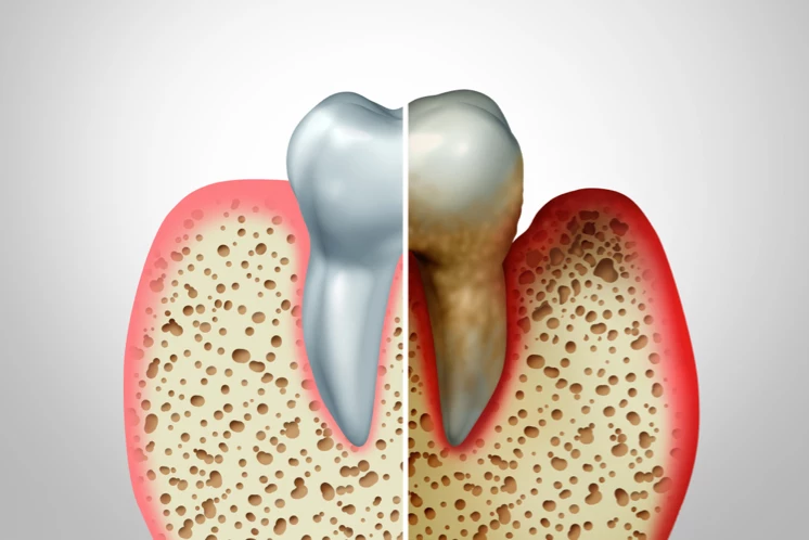 Perdida de hueso dental