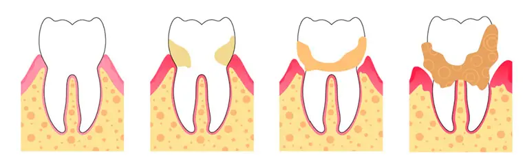 Cómo evitar el sarro en los dientes - Cínical Dental Adeslas