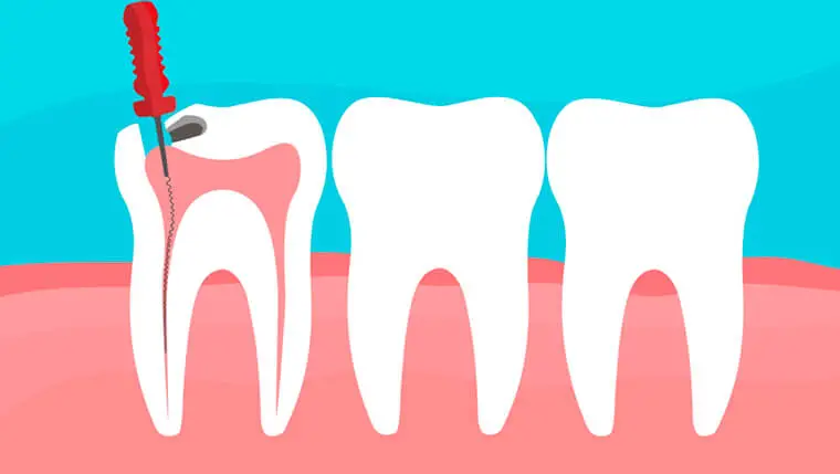 Proceso y cuidados de una pulpotomía - Clínica Dental Adeslas