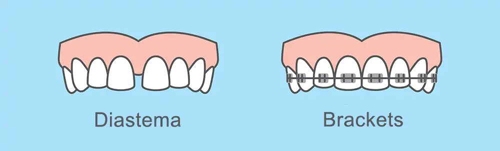 Cómo modificar o corregir el diastema - Adeslas Dental