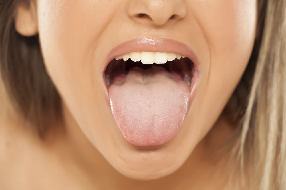 llengua amb símptomes d'infecció boca