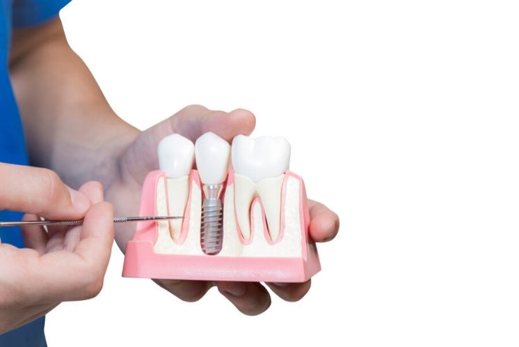 Motlle dents rebuig implant dental