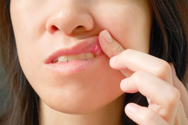 Dona assenyala una berruga en la boca, un dels símptomes del virus del papil·loma humà