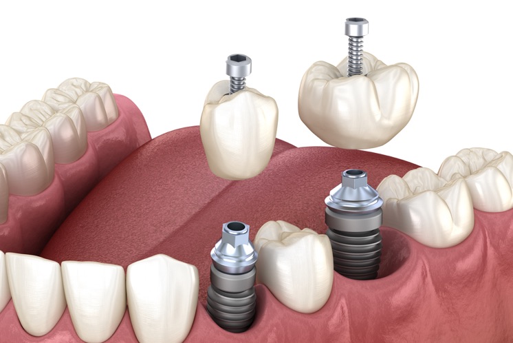 Additaments protètics per a implants, què són?