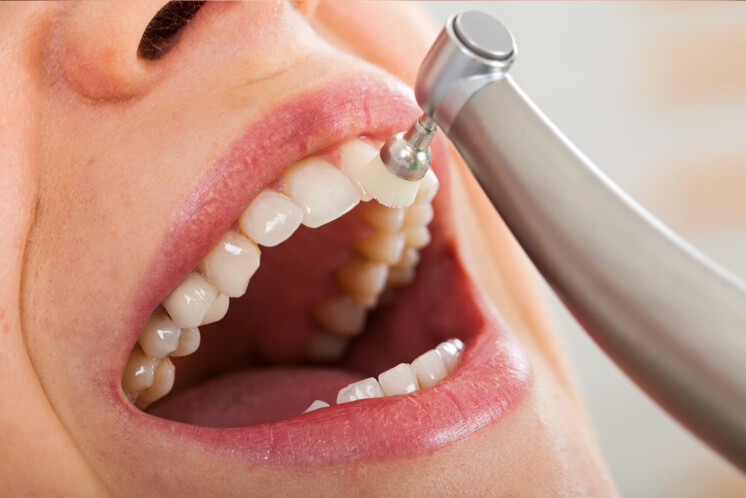 Què és i com funciona la profilaxi dental