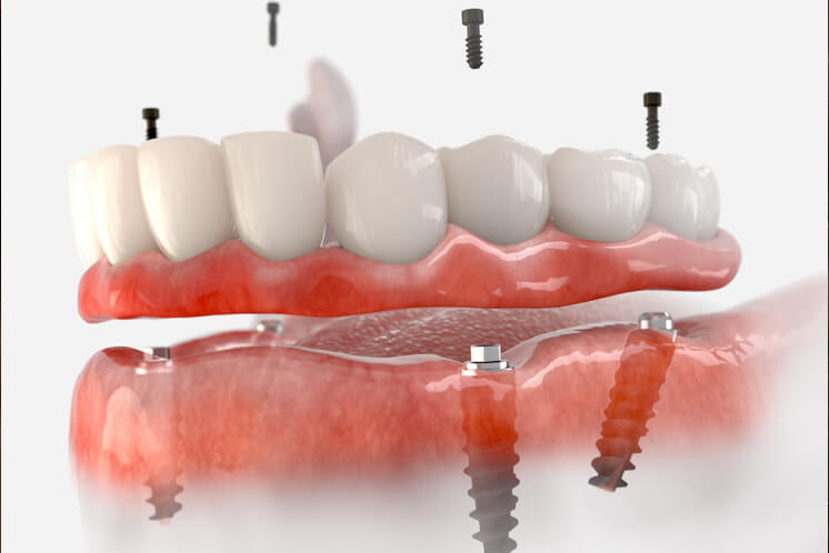 Característiques de les pròtesis híbrides sobre els implants