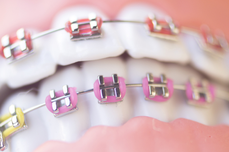riscos de les dents i bràquets casolans o falsos