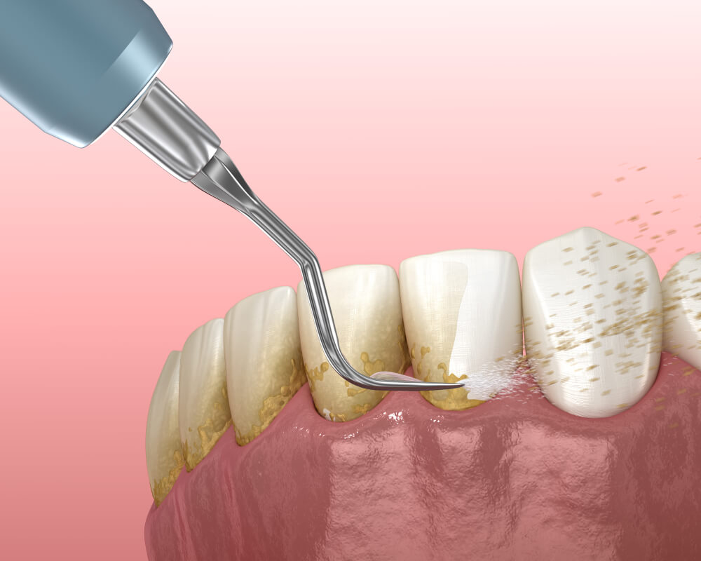 Dental cleaning